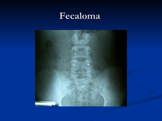 Fecaloma  