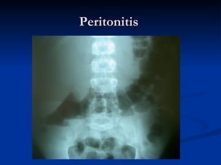 Peritonitis  