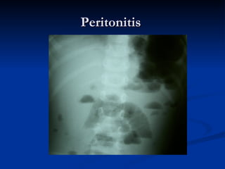 Peritonitis  