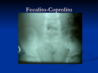 Fecalito-Coprolito 