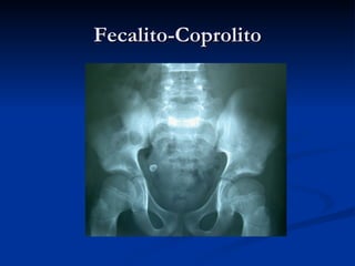 Fecalito-Coprolito 