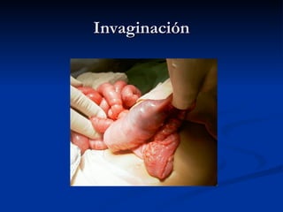 Invaginación 