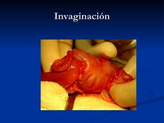 Invaginación 