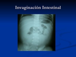 Invaginación Intestinal 