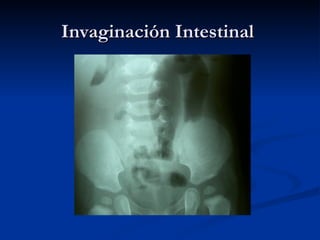 Invaginación Intestinal  