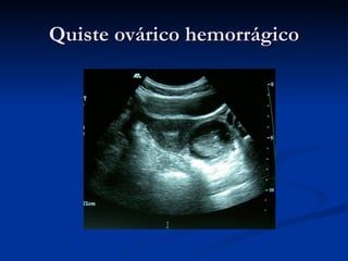 Quiste ovárico hemorrágico 