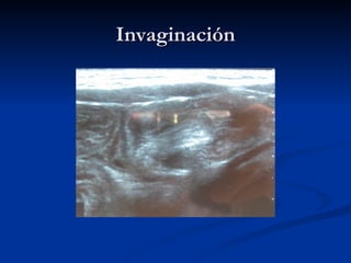 Invaginación 