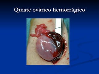 Quiste ovárico hemorrágico 