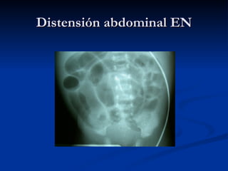 Distensión abdominal EN 