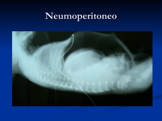 Neumoperitoneo 