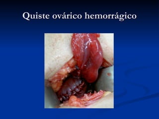 Quiste ovárico hemorrágico 