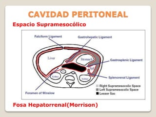 CAVIDAD PERITONEAL
Espacio Supramesocólico
Fosa Hepatorrenal(Morrison)
 