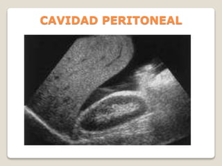 CAVIDAD PERITONEAL
 