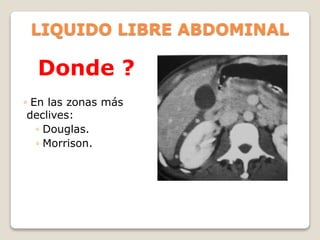 LIQUIDO LIBRE ABDOMINAL
Donde ?
◦ En las zonas más
declives:
◦ Douglas.
◦ Morrison.
 