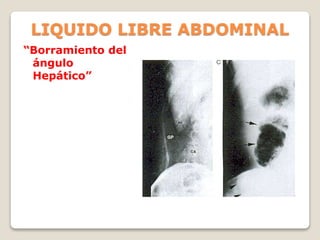LIQUIDO LIBRE ABDOMINAL
“Borramiento del
ángulo
Hepático”
 