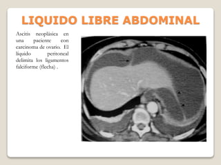 LIQUIDO LIBRE ABDOMINAL
Ascitis neoplásica en
una paciente con
carcinoma de ovario. El
líquido peritoneal
delimita los ligamentos
falciforme (flecha) .
 