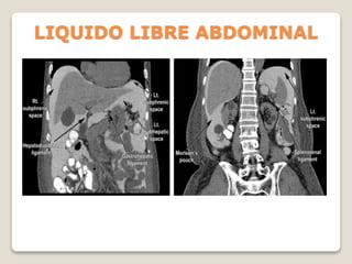 LIQUIDO LIBRE ABDOMINAL
 