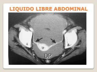LIQUIDO LIBRE ABDOMINAL
 