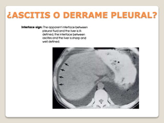 ¿ASCITIS O DERRAME PLEURAL?
 