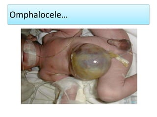 Omphalocele…

 