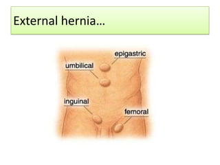 External hernia…

 