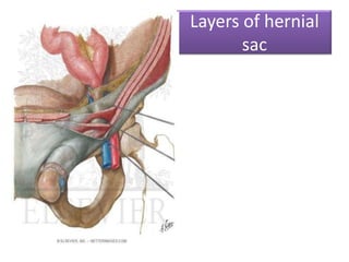 Layers of hernial
sac

 