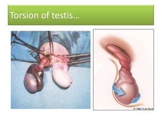 Torsion of testis…

 
