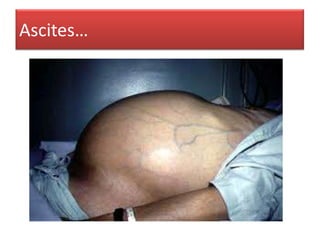 Ascites…

 