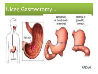 Ulcer, Gasrtectomy…

 