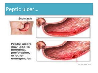 Peptic ulcer…

 