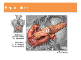 Peptic ulcer…

 