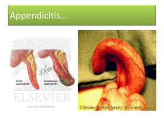 Appendicitis…

 
