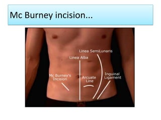 Mc Burney incision...

 