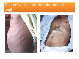 Dilated veins anterior abdominal
wall…

 