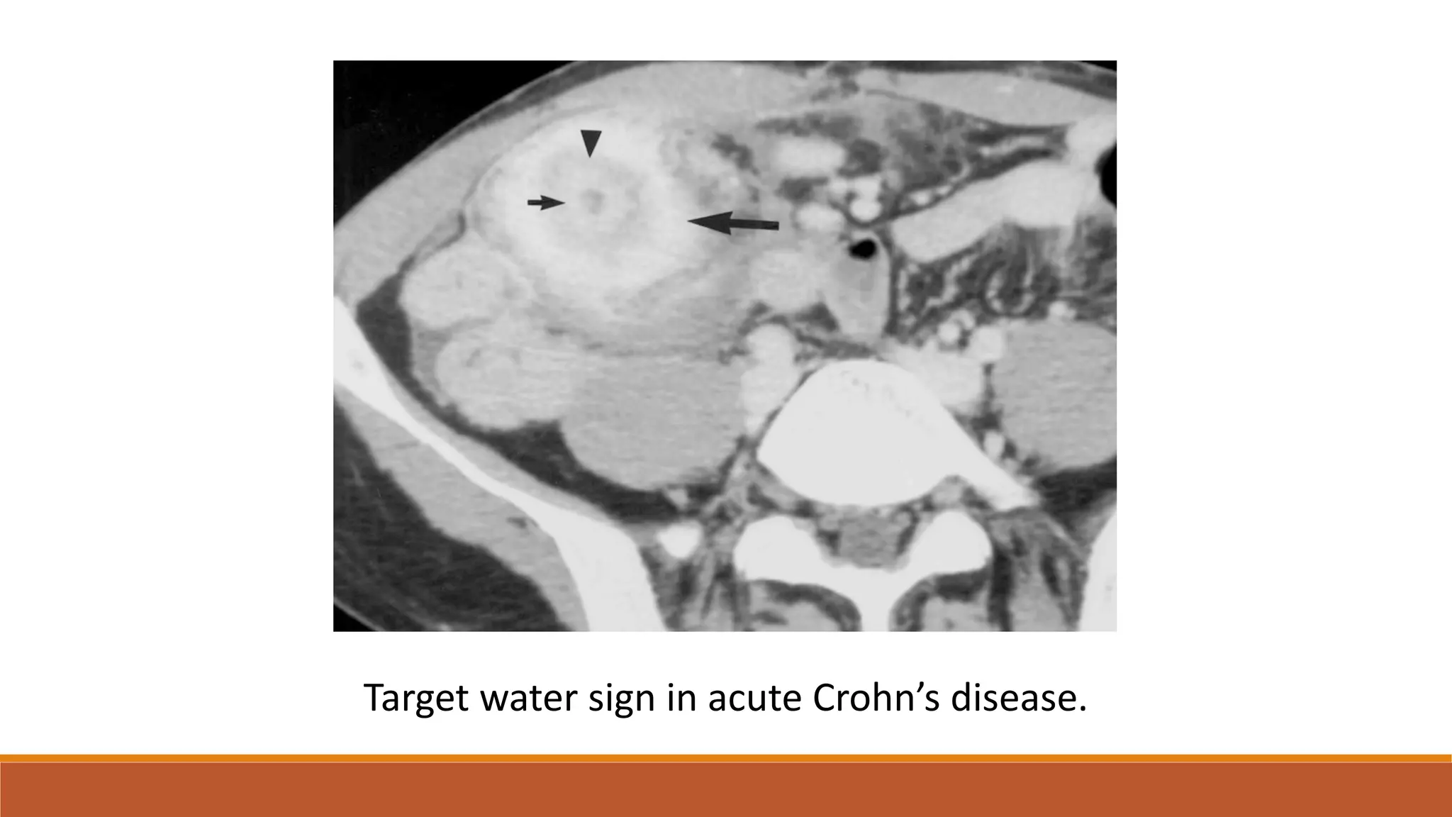 Abdominal radiology pattern recognition | PDF