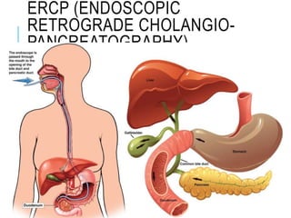 ERCP (ENDOSCOPIC
RETROGRADE CHOLANGIO-
PANCREATOGRAPHY)
 