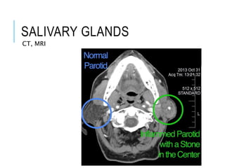 SALIVARY GLANDS
CT, MRI
 