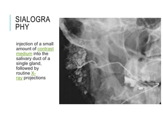 SIALOGRA
PHY
injection of a small
amount of contrast
medium into the
salivary duct of a
single gland,
followed by
routine X-
ray projections
 