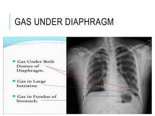 GAS UNDER DIAPHRAGM
 