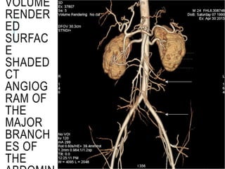 VOLUME
RENDER
ED
SURFAC
E
SHADED
CT
ANGIOG
RAM OF
THE
MAJOR
BRANCH
ES OF
THE
 