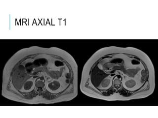 MRI AXIAL T1
 