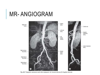 MR- ANGIOGRAM
 