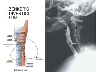 ZENKER’S
DIVERTICU
LUM
 