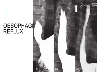 OESOPHAGEAL
REFLUX
 