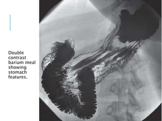 Double
contrast
barium meal
showing
stomach
features.
 