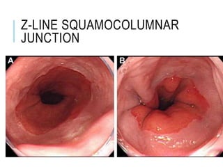Z-LINE SQUAMOCOLUMNAR
JUNCTION
 