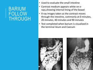 BARIUM
FOLLOW
THROUGH
 