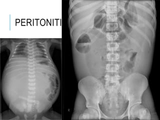 PERITONITIS
 