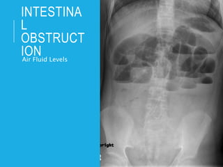 INTESTINA
L
OBSTRUCT
ION
Air Fluid Levels
 