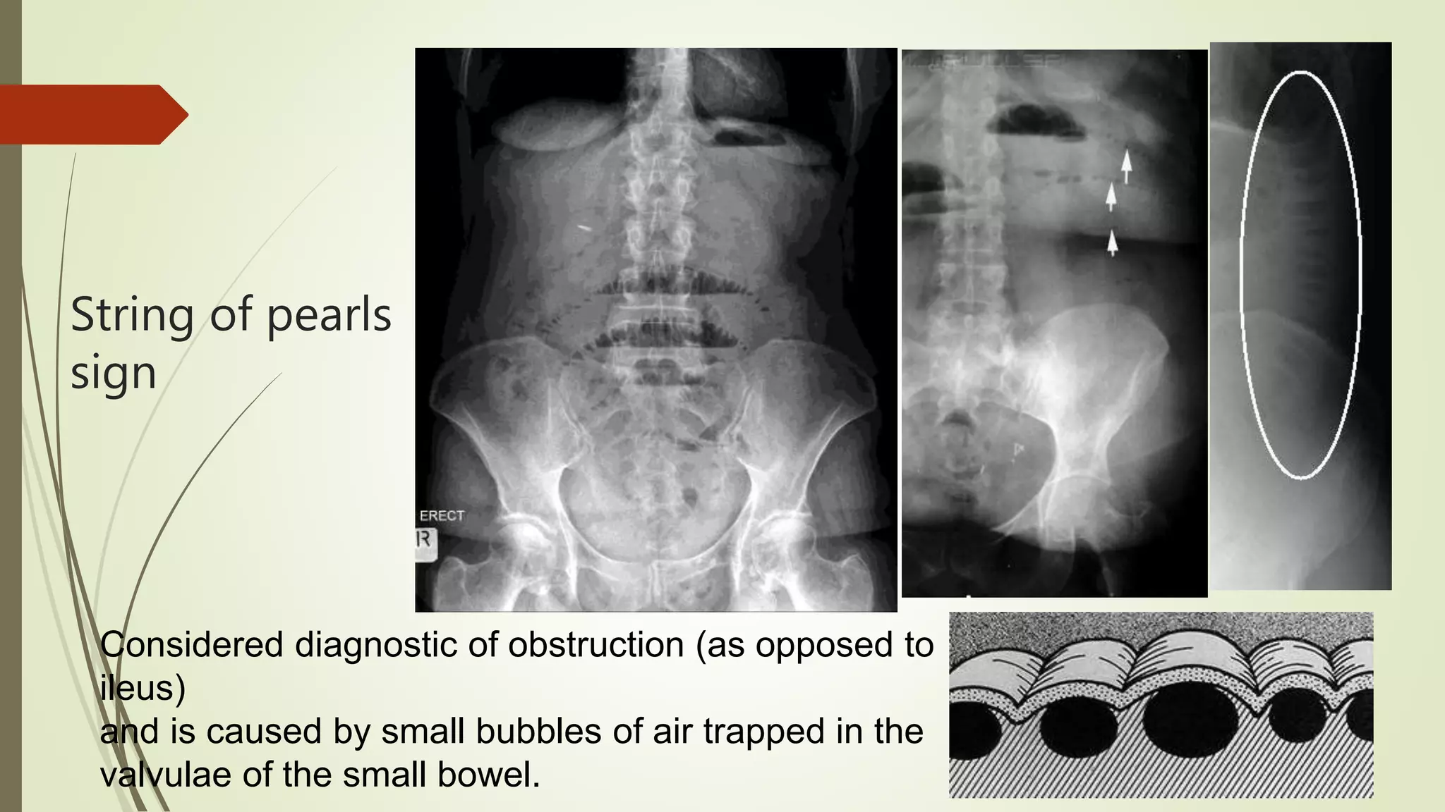 Abdominal X ray Interpretation Ppt PPTX